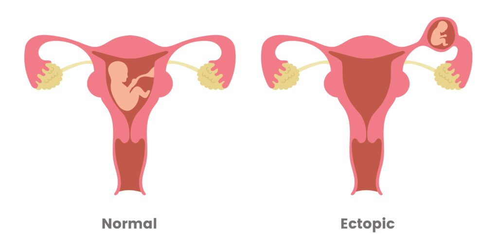 Ectopic Pregnancy