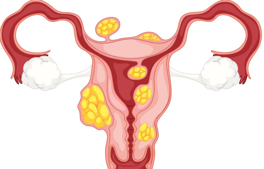 Uterine Fibroids